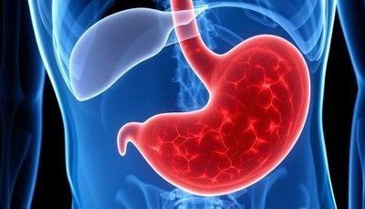 【健康科普】警惕“沉默的胃癌”——早发现早预防 守护胃部健康