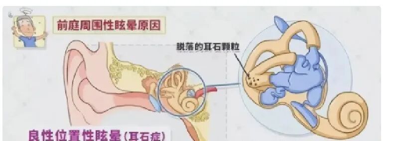 【健康科普】头晕和眩晕分不清？我来告诉你