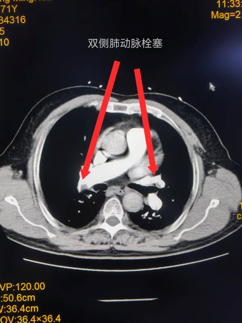 无缝衔接救急症 精准配合护生命——玉林市红十字会医院多团队紧密配合成功完成急诊重症肺动脉取栓术