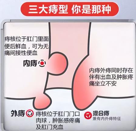 【健康科普】别羞于看痔疮！从预防到治疗，完整痔疮科普来啦