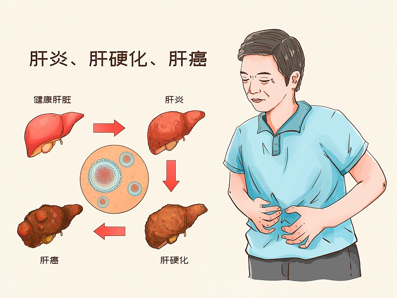 【健康科普】洞察肝癌早期信号 筑牢生命健康防线
