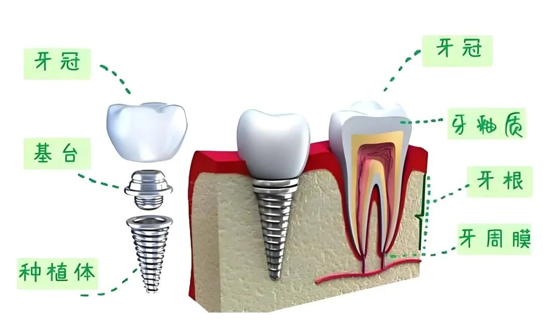 【健康科普】告别缺牙困扰  种植牙技术让牙齿“重生”