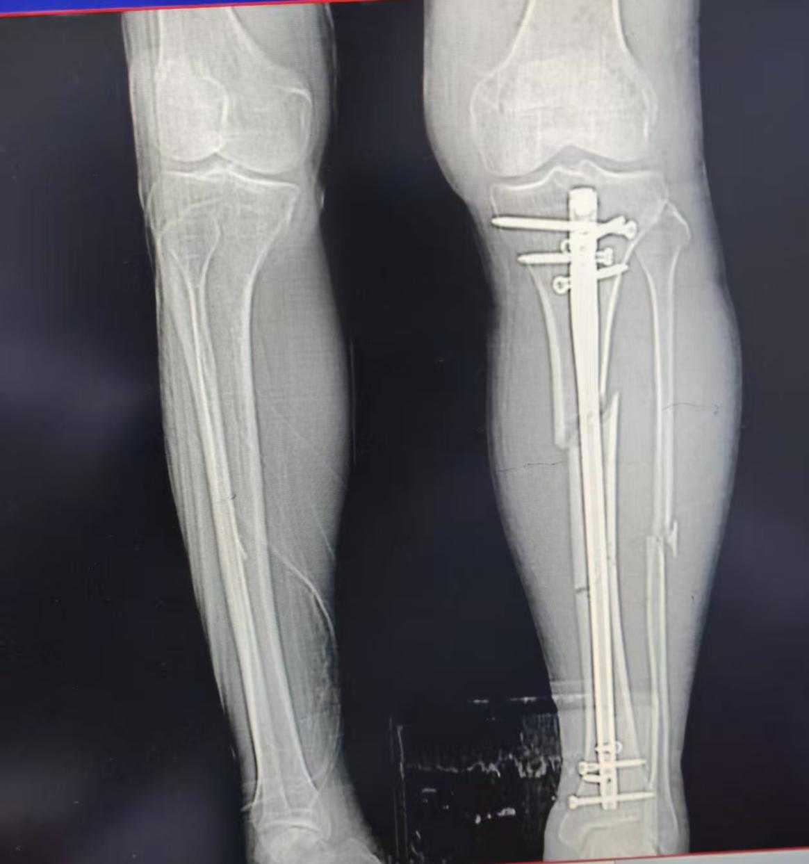 【医疗技术】微创精准“接骨” 小切口解决大难题——玉林市红十字会医院成功实施高难度胫骨多段骨折手术